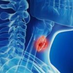 افزایش آمار تشخیص بدخیمی‌های تیروئیدی